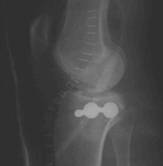 Fracturas de meseta tibial