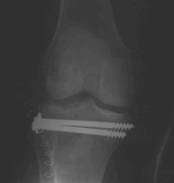 Fracturas de meseta tibial