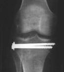 Fracturas de meseta tibial