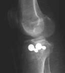 Fracturas de meseta tibial