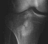 Fracturas de meseta tibial