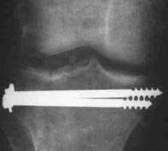 Fracturas de meseta tibial