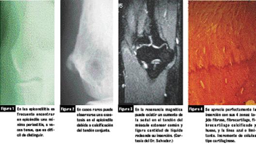 epicondilitis en tenistas