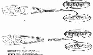 Parálisis obstétricas braquiales