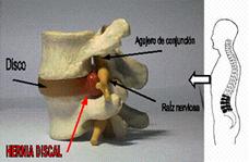 hidroterapia y fisioterapia en discopatias lumbares