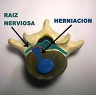 hidroterapia y fisioterapia en discopatias lumbares