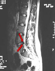 hidroterapia y fisioterapia en discopatias lumbares