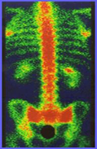 hidroterapia y fisioterapia en discopatias lumbares