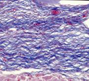 ultrasonoforesis cicatriz hipertrófica