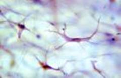 ultrasonoforesis cicatriz hipertrófica