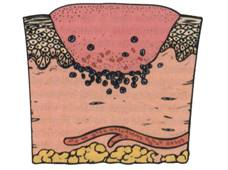 ultrasonoforesis cicatriz hipertrófica