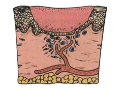 ultrasonoforesis cicatriz hipertrófica