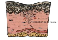 ultrasonoforesis cicatriz hipertrófica