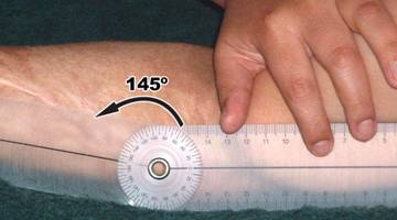 ultrasonoforesis cicatriz hipertrófica