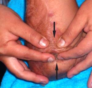 ultrasonoforesis cicatriz hipertrófica