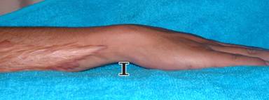 ultrasonoforesis cicatriz hipertrófica