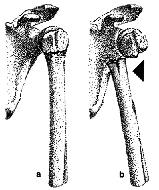 Fracturas proximales de húmero