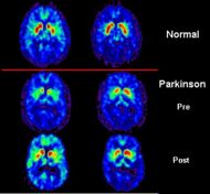 Tratamiento interdisciplinar de parkinson