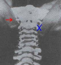 Test de seguridad cervical