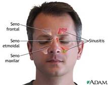 Tratamiento osteopatico sinusitis