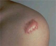 Fisioterapia cicatrices hipertróficas