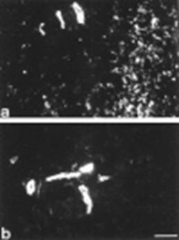 Fisioterapia cicatrices hipertróficas