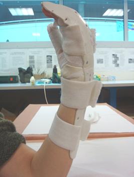 Fisioterapia flexores de la mano