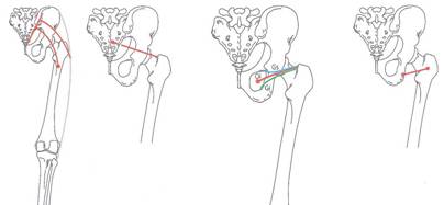 Osteopatía crónica de pubis