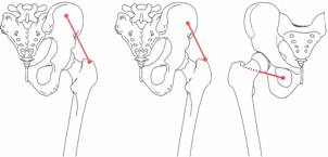 Osteopatía crónica de pubis