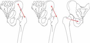 Osteopatía crónica de pubis