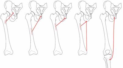 Osteopatía crónica de pubis