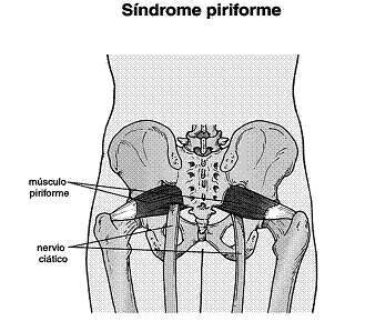 síndrome del piramidal