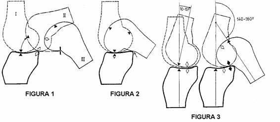 hidroterapia en plastia de ligamento cruzado anteroexterno