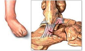 Esguince de tobillo