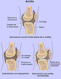 Fisioterapia en la artritis reumatoide