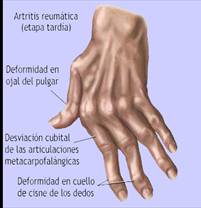 Fisioterapia en la artritis reumatoide