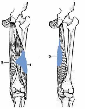 Distensión muscular