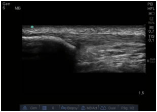 Ecografía musculoesquelética