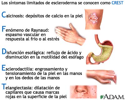 Esclerodermia y fisioterapia