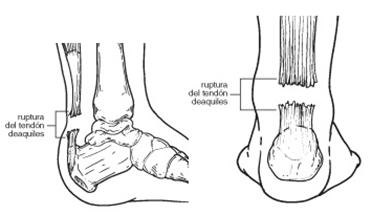 musculatura pierna posterior tendon aquiles
