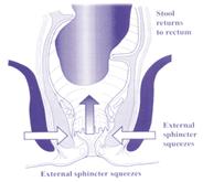 fisioterapia perineal en pediatría