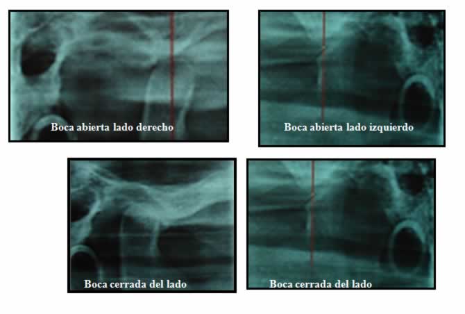 Reabsorción condilar idiopatica