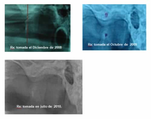 Reabsorción condilar idiopatica