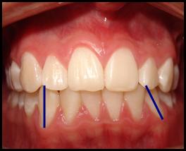 Reabsorción condilar idiopatica