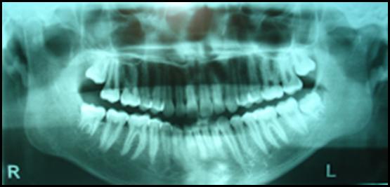 Reabsorción condilar idiopatica