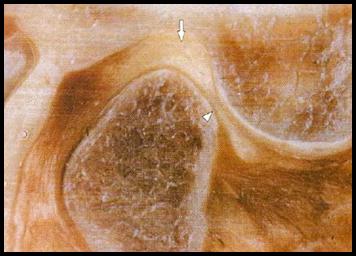 Reabsorción condilar idiopatica