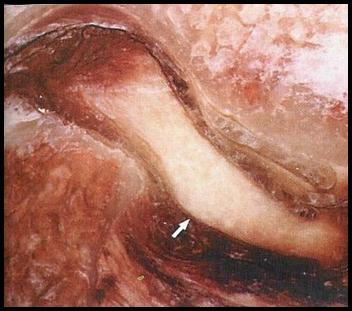 Reabsorción condilar idiopatica