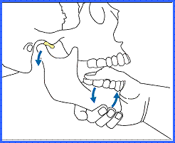 Reabsorción condilar idiopatica