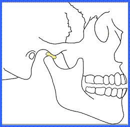 Reabsorción condilar idiopatica