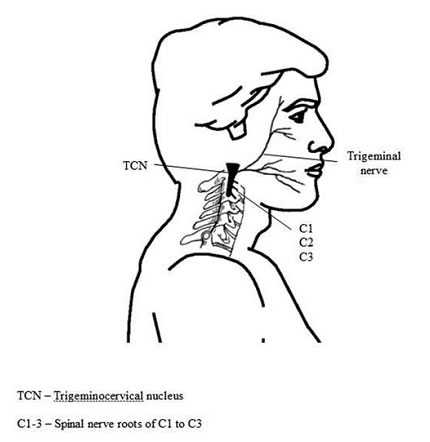 Cefalea cervicogénica